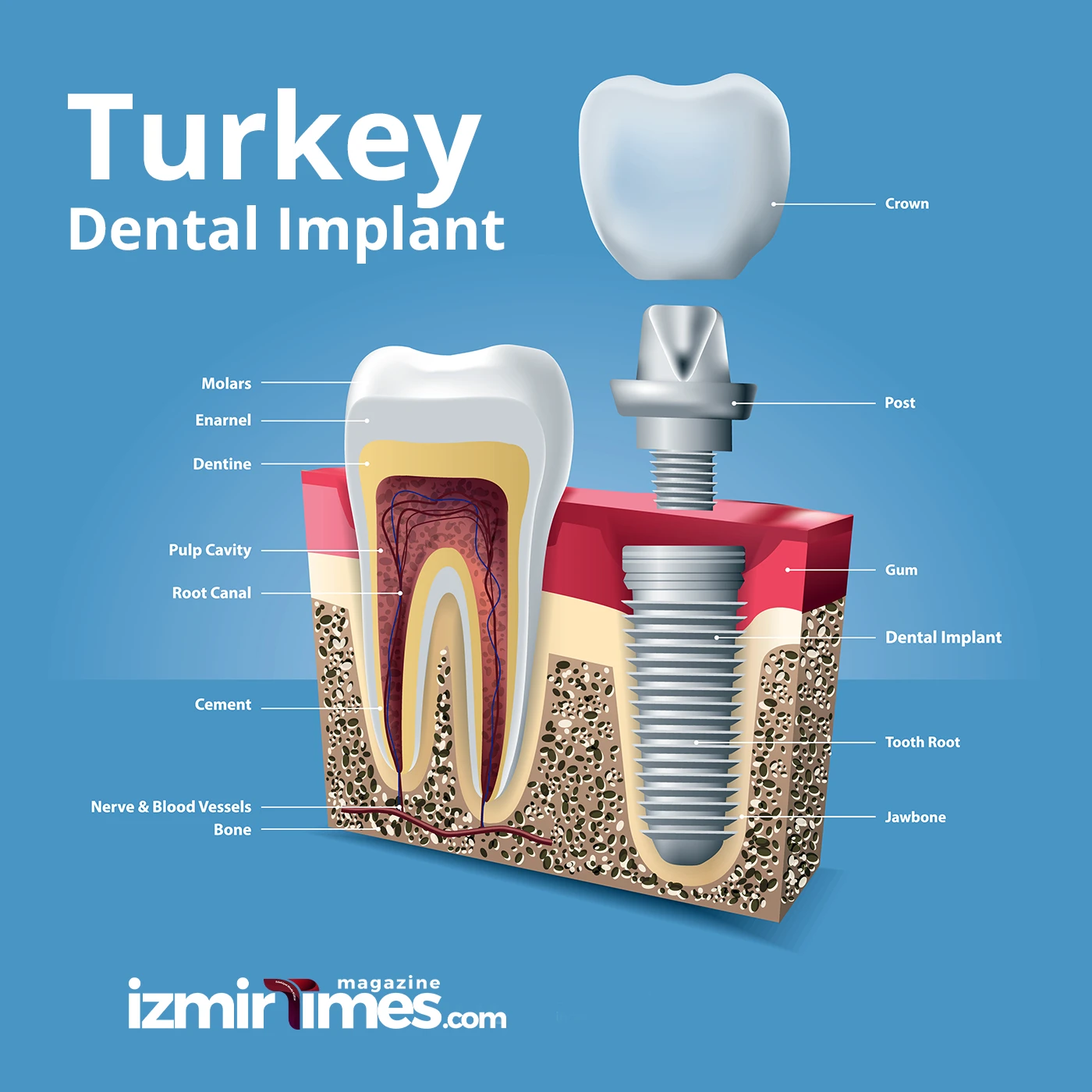 Turkey Dental Implant
