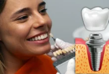 Turkey Dental Implant