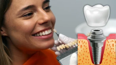 Turkey Dental Implant