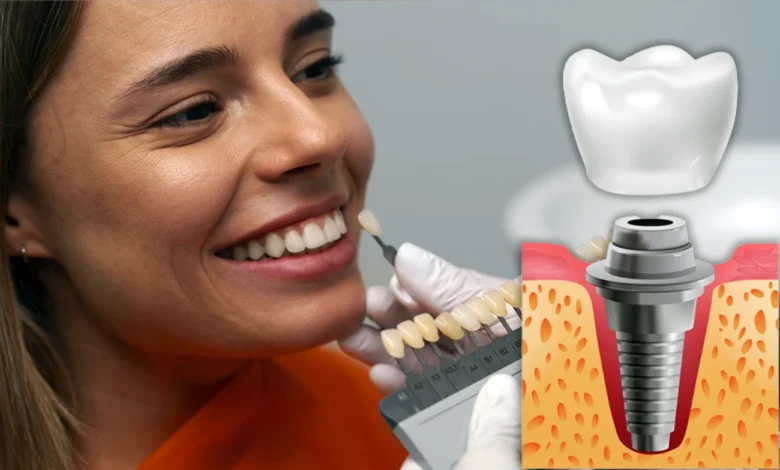 Turkey Dental Implant